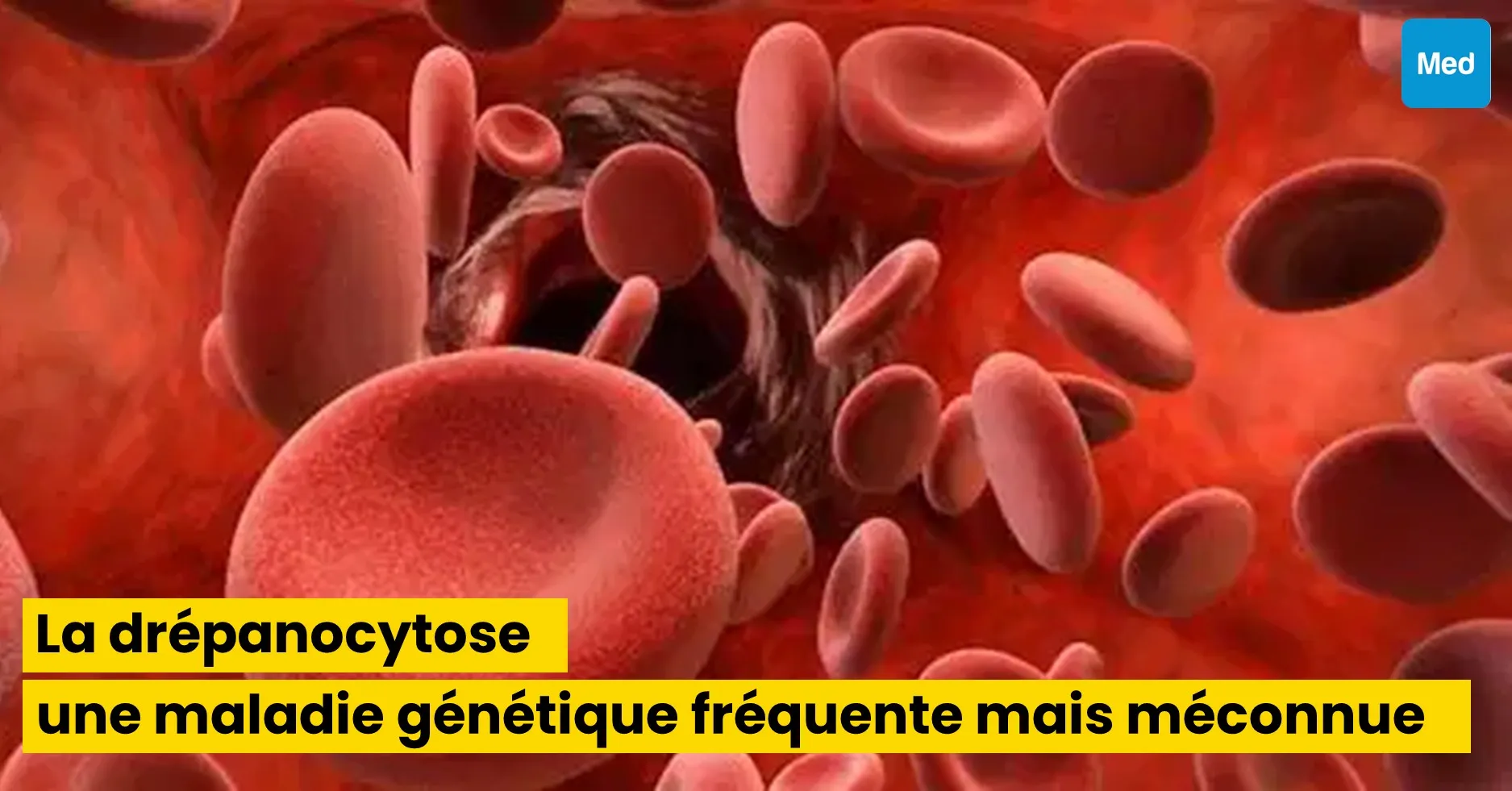 La drépanocytose : une maladie génétique fréquente mais méconnue